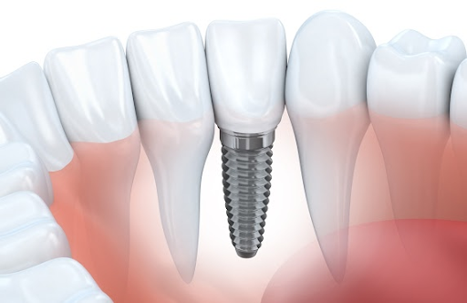 dental implant