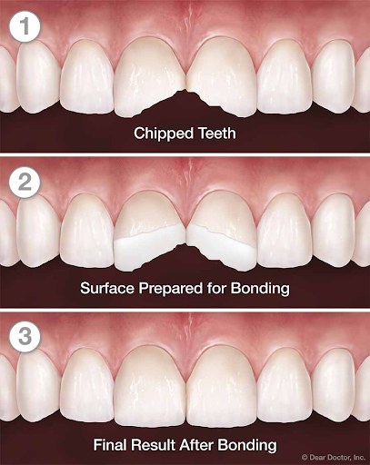 Step by step bonding process