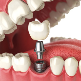 Dental Implants link